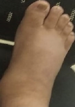 Severe pitting pedal oedema of the right leg of the patient; making it difficult for him to walk or drive his car.